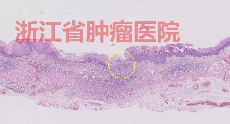 食管大面积黏膜病变,看看这家医院如何处理?!