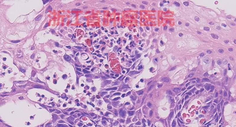 食管大面积黏膜病变,看看这家医院如何处理?!