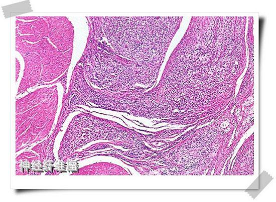 咖啡斑的最佳治疗时间是什么,咖啡斑的发病率高吗