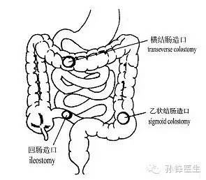 精品原创︱医生，您为什么要让我“挂粪袋”？