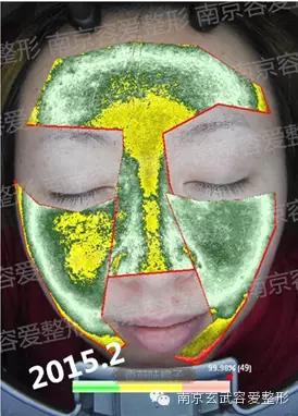 手把手教你如何抗痘,教你有效抗痘6个绝招