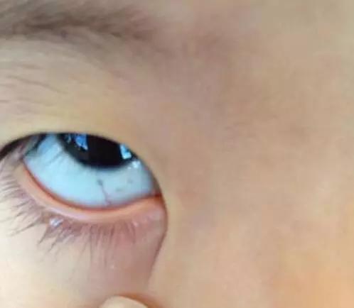 眼白出现这几种颜色，你该警惕了