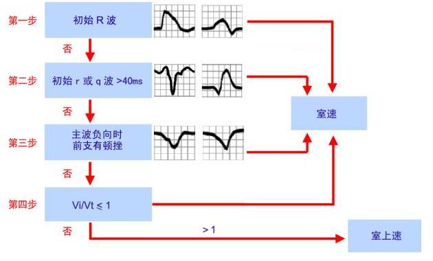 qrs心动过速怎么鉴别,qrs波心动过速解决办法