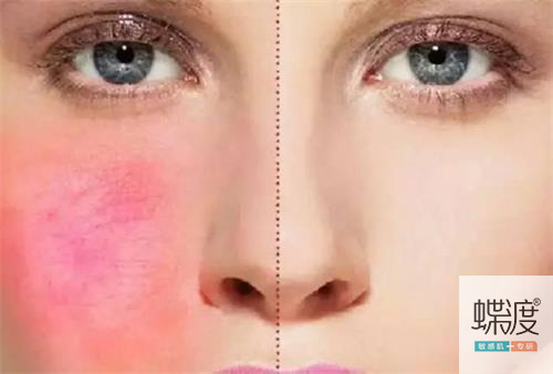 过敏肌肤如何修复肌底,过敏肌适合什么护肤