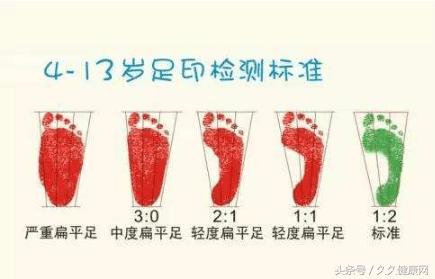 长期穿小一码的鞋会导致扁平足吗,长期穿运动鞋会导致扁平足吗