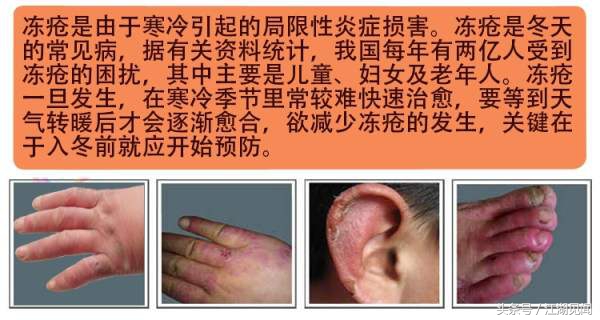 冻疮痛怎么办,冻疮很痛怎么办