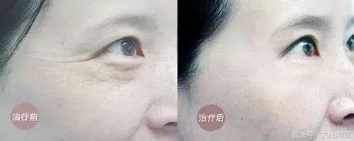 为什么热拉提这么便宜,热拉提多久做一次效果好