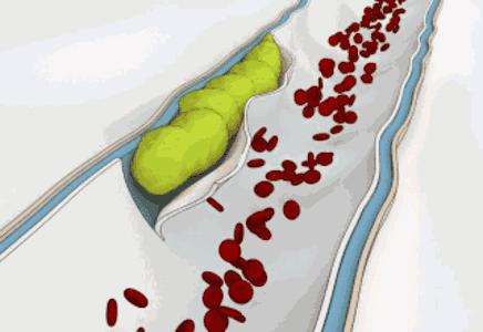 血管决定生老病死：教你六招避免“血管一老、全身跟着老”的险境