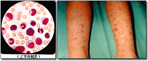 过敏性紫癜能治好吗三个月,过敏性紫癜一个月了怎么治疗