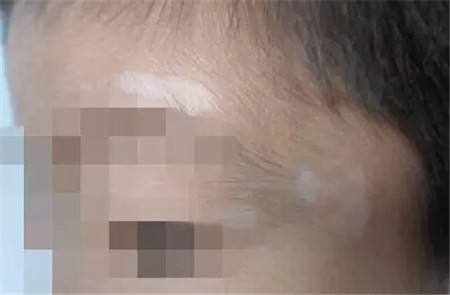 男孩脸上一块块白斑应该怎么弄,孩子脸上长了一块白斑怎么回事