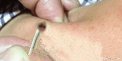 黑痣用针挑了会留疤吗,长黑痣用什么药去掉