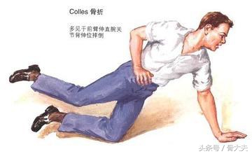 肩关节骨折后遗症表现,骨科医生肩膀手臂疼