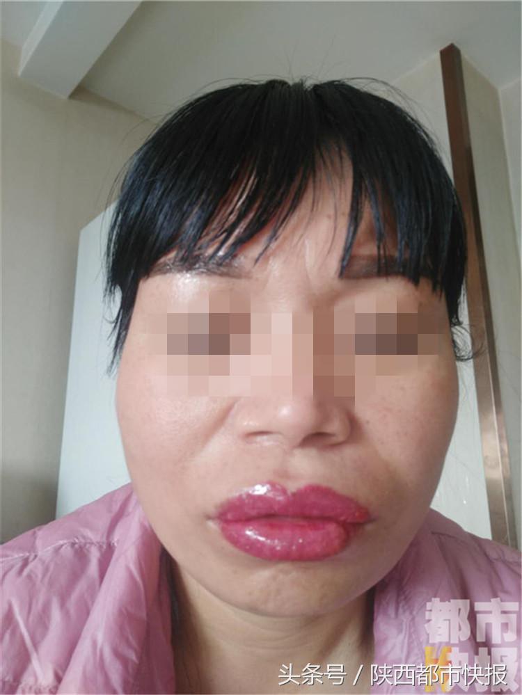 女子千元漂唇肿胀五天如“香肠”