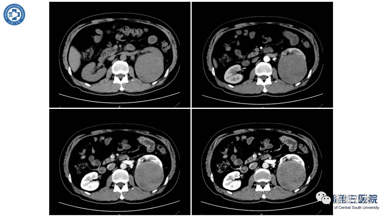 左腰侧边撞伤里面隐隐作痛,左腰被撞现在肚子痛