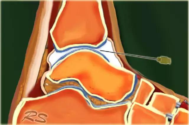 超声引导穿刺和介入穿刺的优缺点,关节超声引导