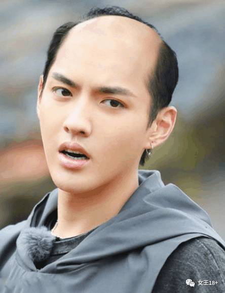 怎么防治中年男士发际线后移,18岁男发际线后移怎么补救