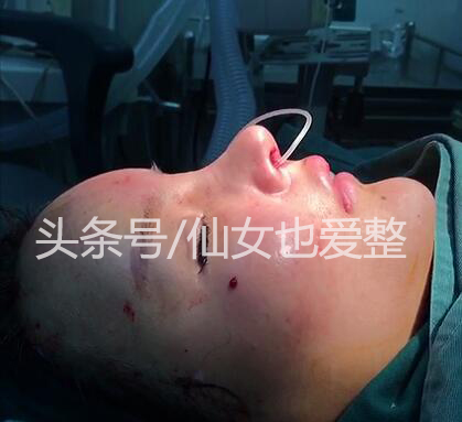 鼻综合隆鼻用什么材料,耳软骨和肋骨隆鼻费用多少钱