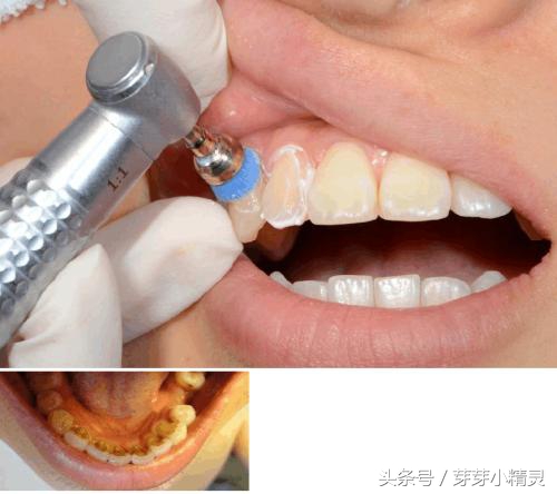 第一次洗牙后牙缝太大了怎么办,为什么洗牙后牙缝越来越大