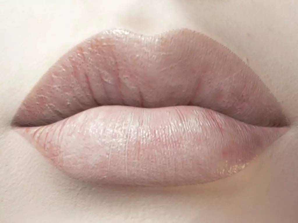 唇炎患者的心酸历程,一个肺病患者的自白