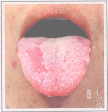 舌诊剥苔,小儿怎样看舌苔辨病症