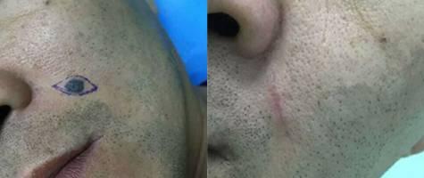 像小瘤一样的痣是什么,有个像疤一样的痣