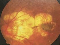 高度近视有必要恐慌吗,高度近视不戴眼镜的危害