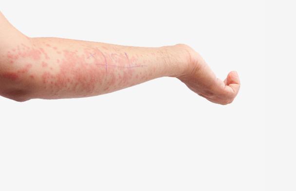 皮肤起红包中间有小水泡点还很痒,皮肤干燥脸上起红包怎么回事