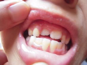 宝宝预防龅牙用什么奶嘴,怎么预防宝宝吃安抚奶嘴变龅牙