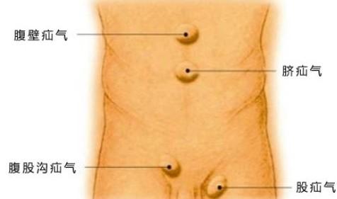疝气腹腔镜手术后有哪些注意事项,老年人疝气手术后饮食注意事项