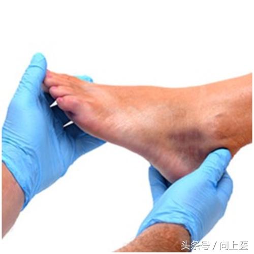 大脚趾关节炎怎么才能好,脚拇指关节炎症状有哪些表现