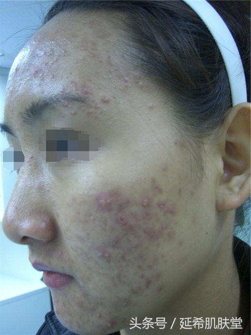 鐥樼棙鏆楃柈鍙互鐢ㄦ殫鐤拡鎸ゅ悧,鏆楃柈閽堟不鏆楃柈