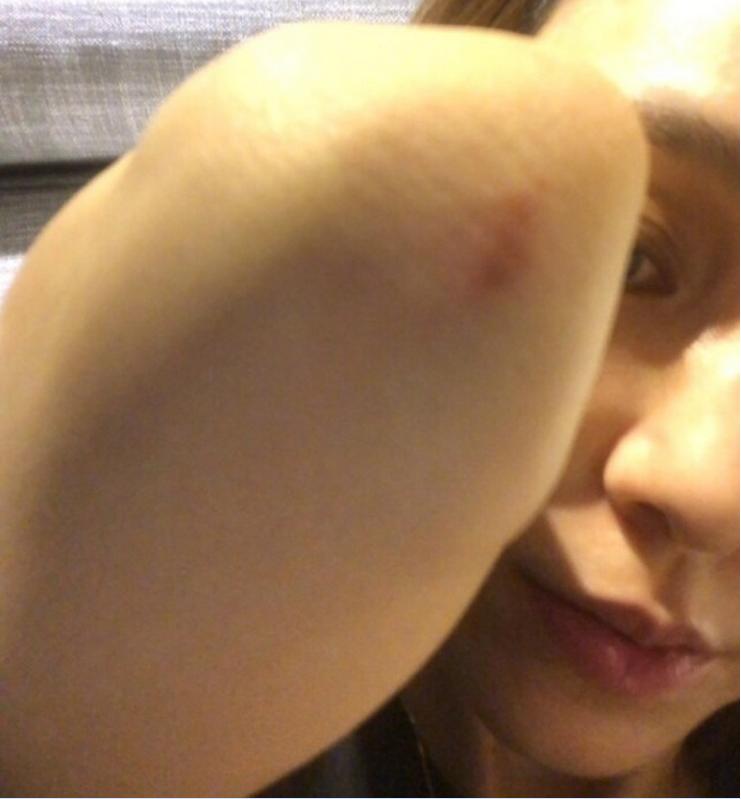 范玮琪受伤的原因,范玮琪受伤事件