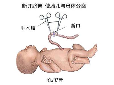 剖腹产全过程,剖腹产20天伤口真实照片