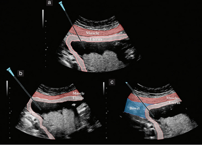 绒毛穿刺会对胎儿发育造成影响吗,绒毛穿刺致胎儿畸形吗
