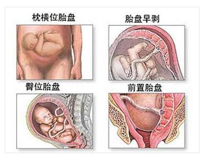 剖腹产全过程,剖腹产20天伤口真实照片