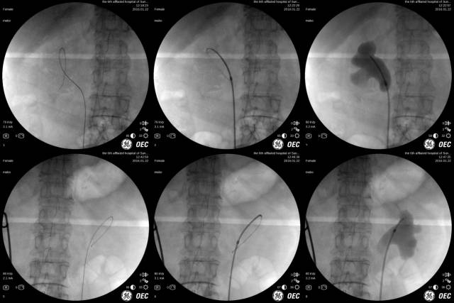 覆膜网状支架治疗输尿管梗阻,输尿管堵塞支架取出后又堵塞