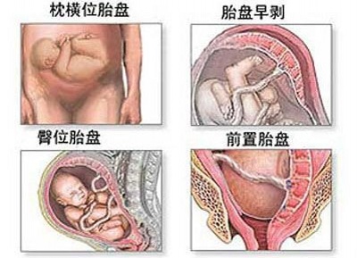 对于选择剖腹产的孕妈妈而言,到底剖腹产是怎样的?(图解)