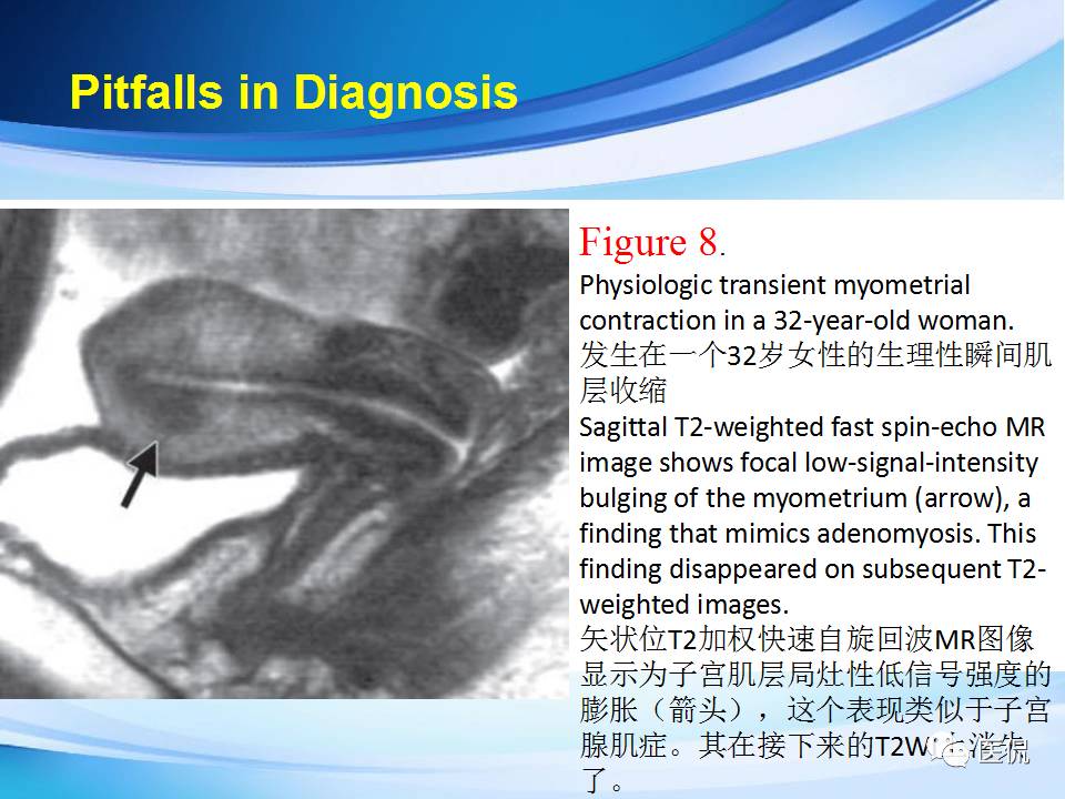 双语PPT：子宫腺肌症常见和不常见的MRI表现医学影像