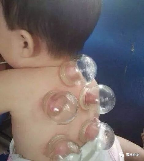 预防儿童感冒中医给你6个方法,儿童感冒西医用药科普