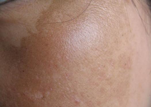 提亮肤色改善暗黄孕妇,孕妇祛黄提亮改善暗沉