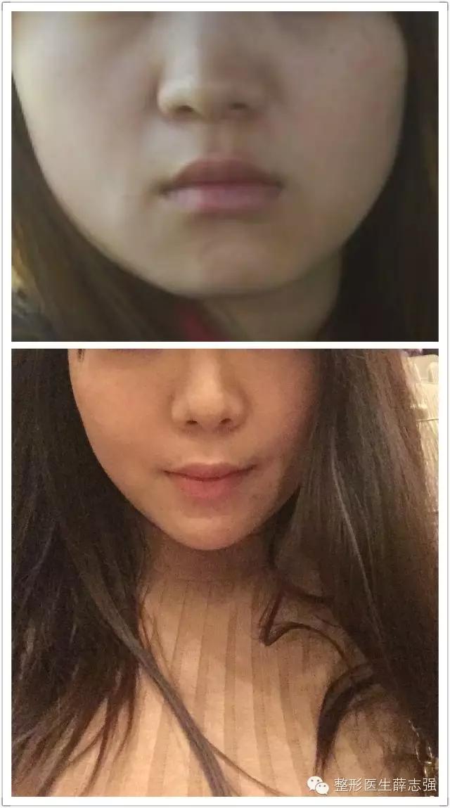 非手术的抗皱紧致怎么做,全脸紧致的方法和原理