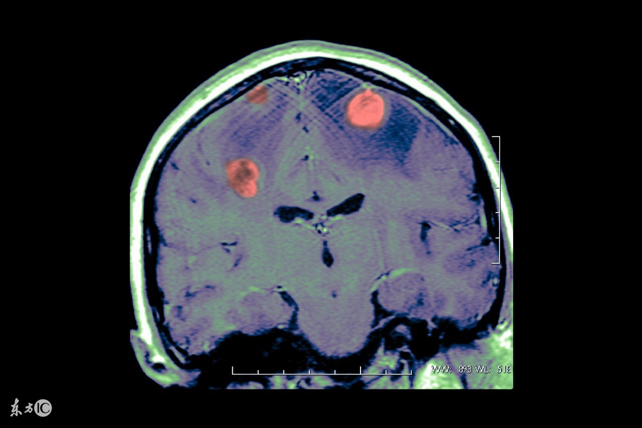 引起儿童良性癫痫的原因是什么,儿童脑病引发的癫痫能根治吗