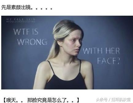 “你如果不长痘一定很好看”——长痘患者的自述