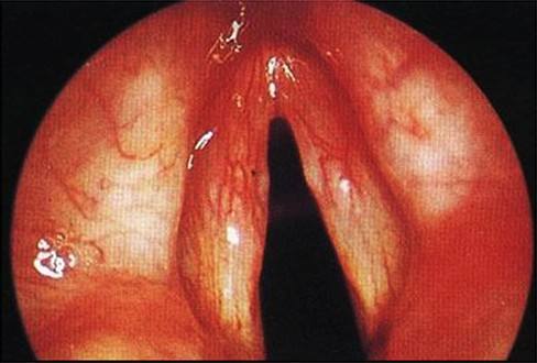 咽炎咳痰多有什么妙法,慢性咽炎痰多最好治疗方法