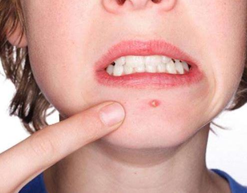 如何防治姨妈前长痘,怎么治疗姨妈痘