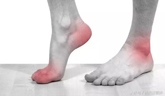 痛风患者的营养治疗注意事项——20180103