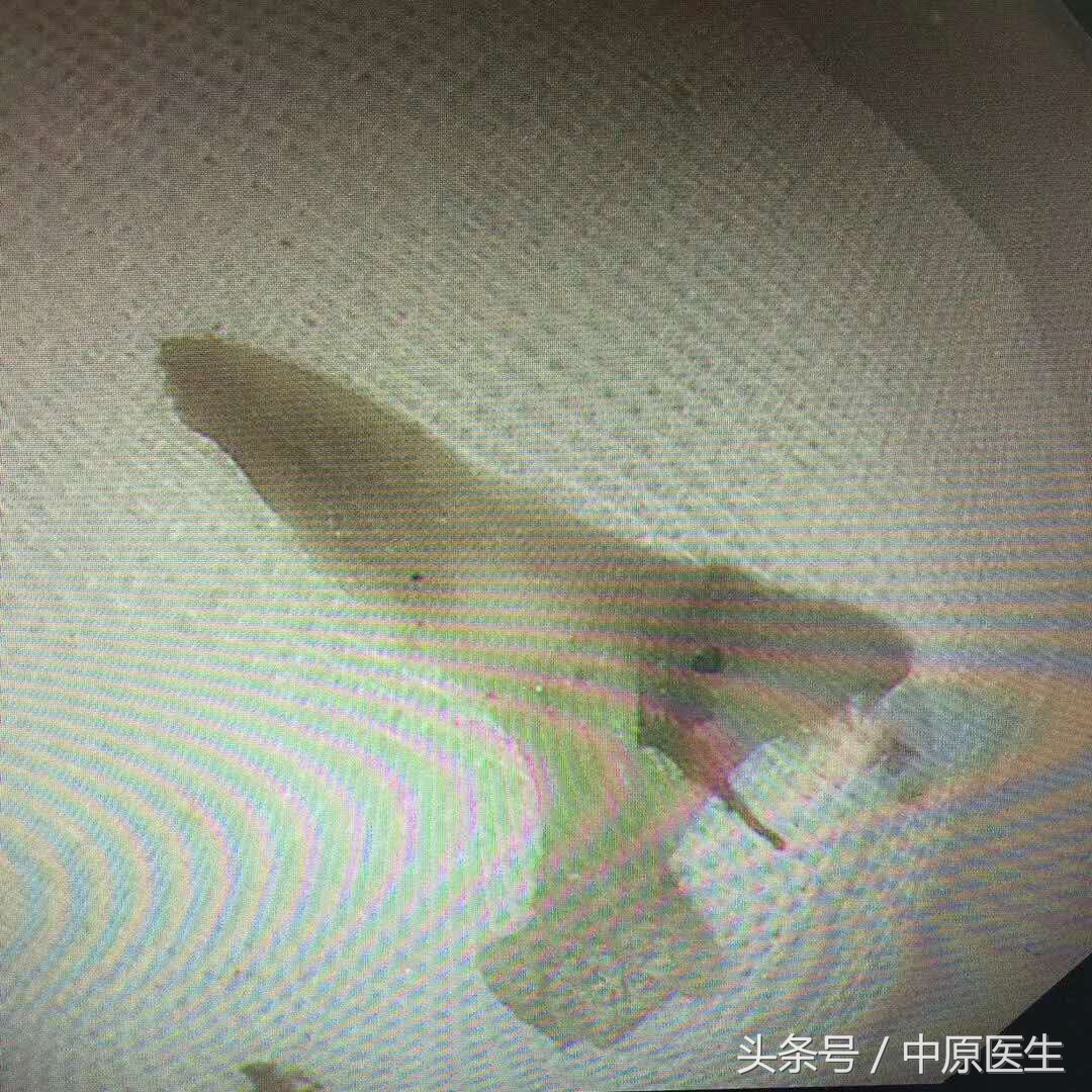 吃东西不小心被卡怎么办,小鱼刺卡到食管怎么办