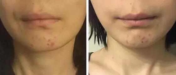 敏感肌卸妆洁面乳,适合敏感肌用的去角质洁面乳