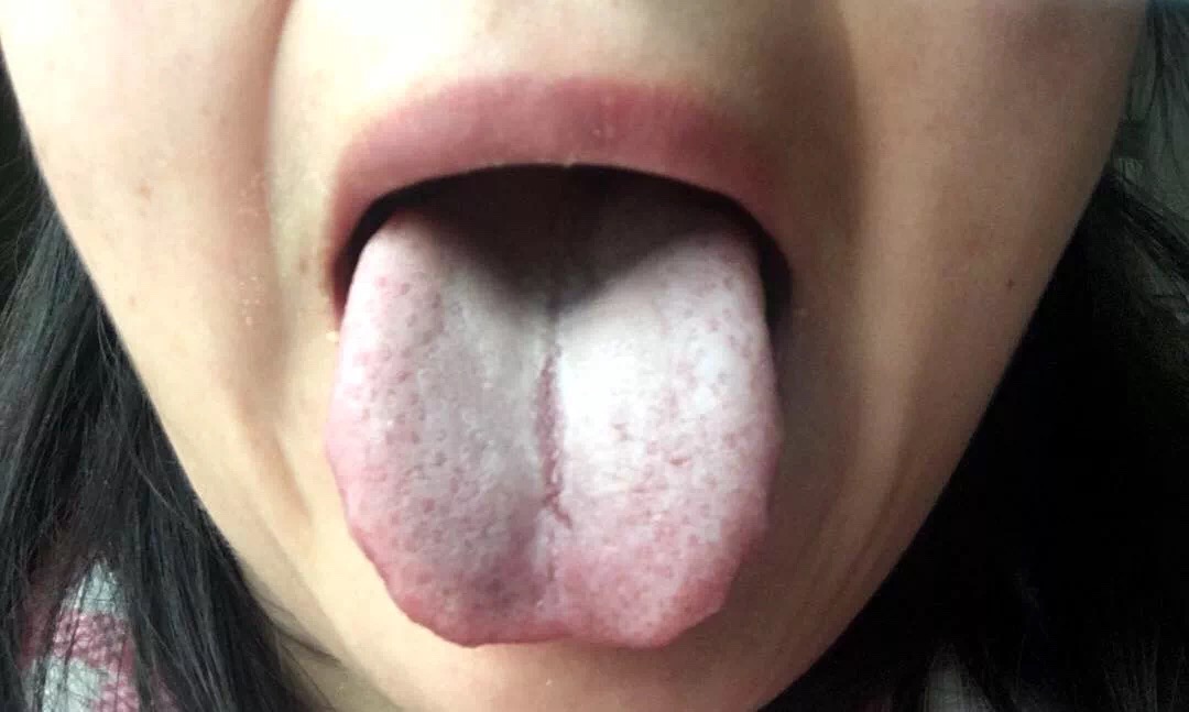 根据舌苔辨别身体情况,舌苔白厚什么原因吃什么中成药