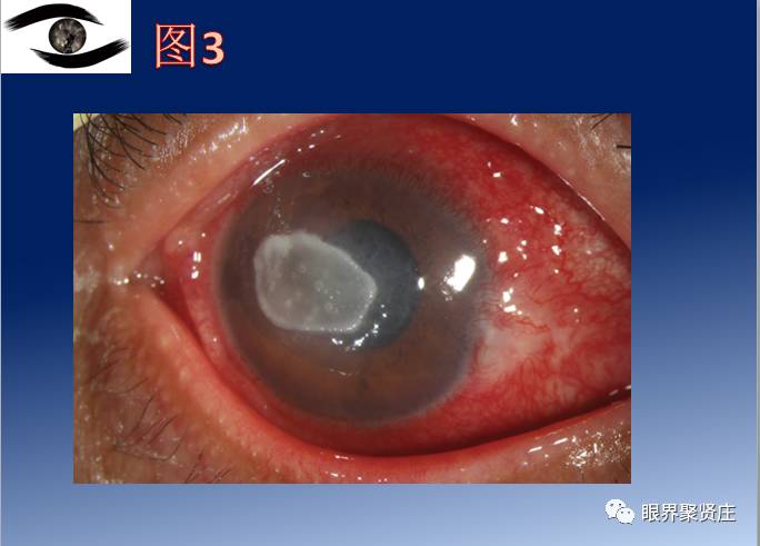 几种眼病的视野图,看图识病是什么病